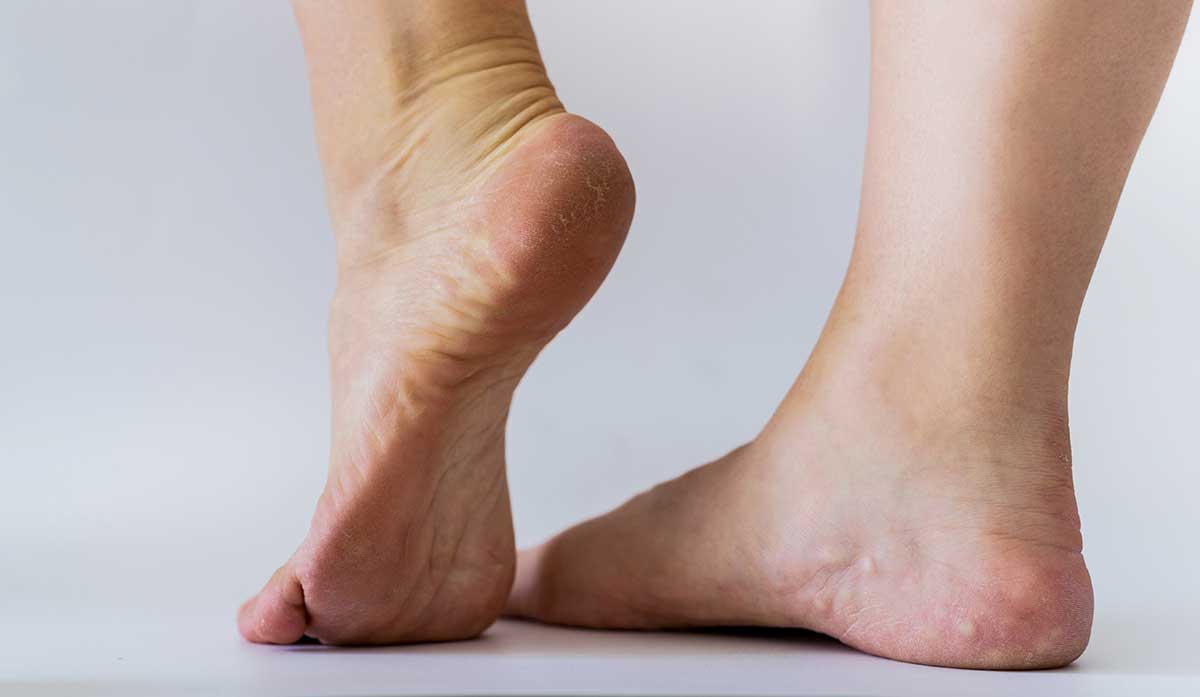 Radiotherapy for Ledderhose Disease (Plantar Fibromatosis)